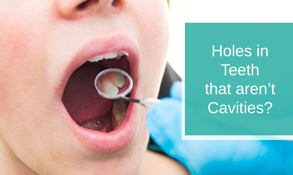 Holes in Teeth that Aren’t Cavities?