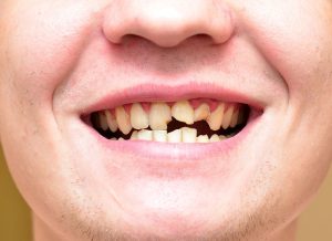 Impacts and Teeth